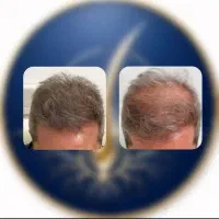 ریزش مو داری یا کم‌پشتی       این برای توعه