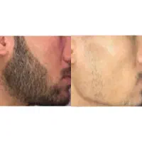 رشد سریع ریش