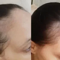 تونیک هیر فرند ریزش مو کم پشتی