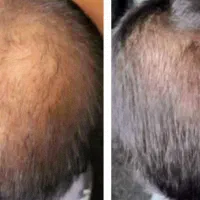 قطعی تضمینی و همیشگی ریزش مو