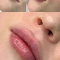 تزریق ژل و بوتاکس ،مزوژل