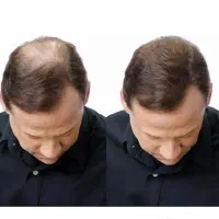 از طاسی تا رشد مجدد(بدون جراحی)