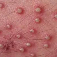 کنترل و رفع زگیل تناسلی
