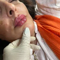 آموزش تیوری واصولی فیلرو بوتاکس با پشتیبانی۲۴ساعته