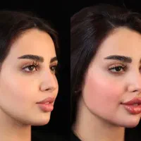 فیلرلب،ژل،چونه،پی ارپی،جوانساز|خدمات زیبایی و سلامت|کرج, جهان‌شهر|دیوار