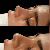 عمل جراحی بینی روش معمولی وبا دستگاه پیزو/فوق تخصص