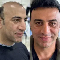 کاشت مو طبیعی با تخفیف روز مرد