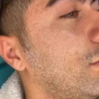لیزر co2فرکشنال صورت و بدن