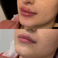 بوتاکس ژل فیلر چربی مزوژل جالوپرو نخ لیف