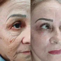 بوتاکس پیشانی،اخم و زیربغل در محمدشهر توسط پزشک