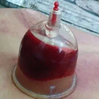 .الحجامه . حجامت وبادکش.  ادرس چومه سید علوان