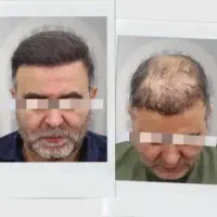 برای اولین بار رویش مجدد مو
