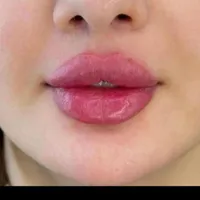جشنواره بهاره تزریق ژل وبوتاکس توسط پزشک متخصص