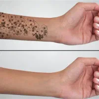 پاک کردن تتو و لیزر کل بدن