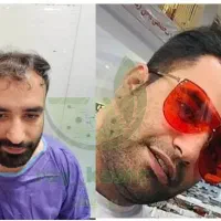 کاشت ابرو و مو