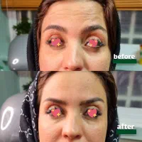 بوتاکس کل صورت فقط ۹۵۰ به تعداد محدود