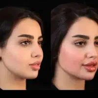 کلینیک بوکال فت8/800بلفاروپلاستی8/900ساکشن8/900