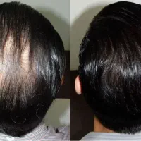 ریزش مو برطرف میشه اگر بخواهی