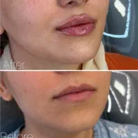 تزریق ژل، بوتاکس و مزوژل prp بایوفیلر