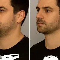 جوانسازی صورت اقایان