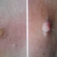 سوراخ کردن گوش ،خالبرداری و برداشتن زگیل در مطب