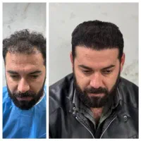 کاشت مو با تراکم بالا تمام اقساطی