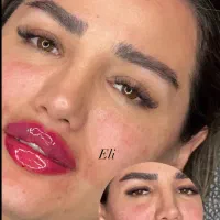 ژل لب گونه گونه زاویه فک و بوتاکس ۲۹۹ تا آخر هفته