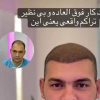 کاشت مو ریش ابرو و زیبایی