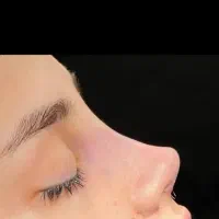 جراحی بینی تضمینی با ریکاوری سریع