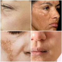 چین و چروک و لک با جدیدترین متد اروپا