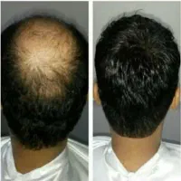 رمز قطع ریزش مو