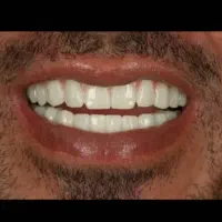 ایمپلنت دیجیتال  عصب کشی ترمیم روکش