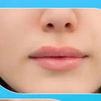 نیاز به مدل جهت تزریق فیلر لب