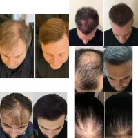 اگه ریزش مو داری سلام کن
