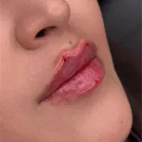 ژل بوتاکس تزریق مزو پی آر پی(سابسیژن)فیلر آلت