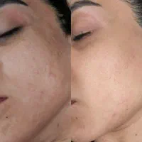 جوانسازرفع لک رفع ریزش مو پی ار پی در مطب پزشک 385