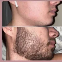 محصولات ویژه پرپشتی ظاهری مو و ریش