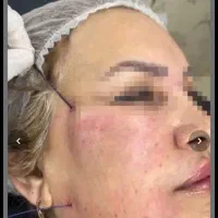 ژل  نخ لیفت صورت جوانسازی در ده دقیقه  زیر چشم