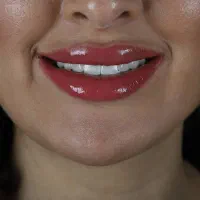 دندانسازی دندان مصنوعی طرح لمینت
