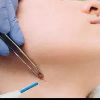 بهبود زگیل تناسلی