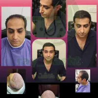کاشت ابرو ، مو ، ریش ( ضمانت نامه کتبی )