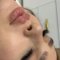 تخفیف ویژه امروز تزریق ژل و بوتاکس وساکشن (ققنوس
