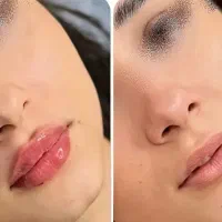 جشنواره خدمات زیباییVIPبوتاکس/فیلر/مزوتراپی/فیشیال