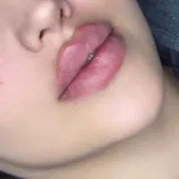 تخفیف ویژه تزریق فیلر صورت