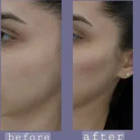 مدل جهت تزریق ژل