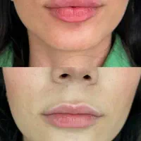 خدمات ژل صورت لب چونه گونه زاویه