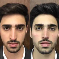 تخصصی ترین مرکز فیلر بادی و کانتورینگ