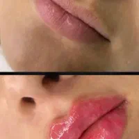 تزریق فیلر ، بوتاکس و پرسینگ و آموزش شیراز، نصر