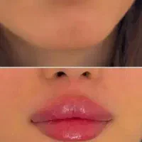 تزریق ژل وبوتاکس
