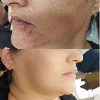 جوانسازی حذف تمامی نواقص پوست